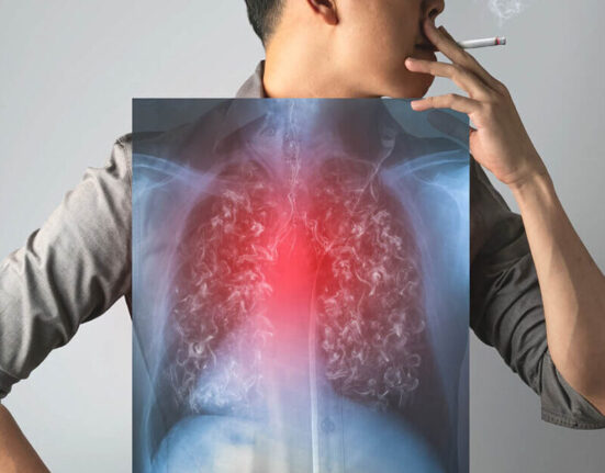 Risk factors for lung cancer