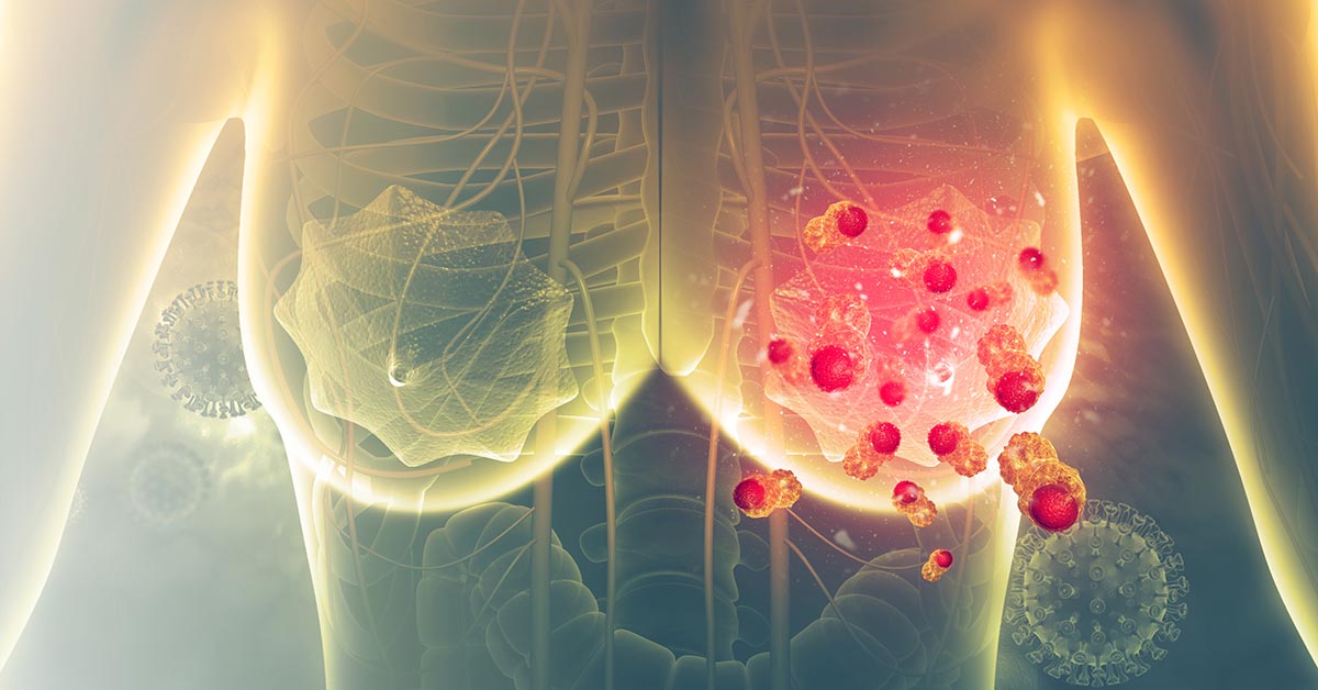 Illustration symbolising the signs and symptoms of breast cancer
