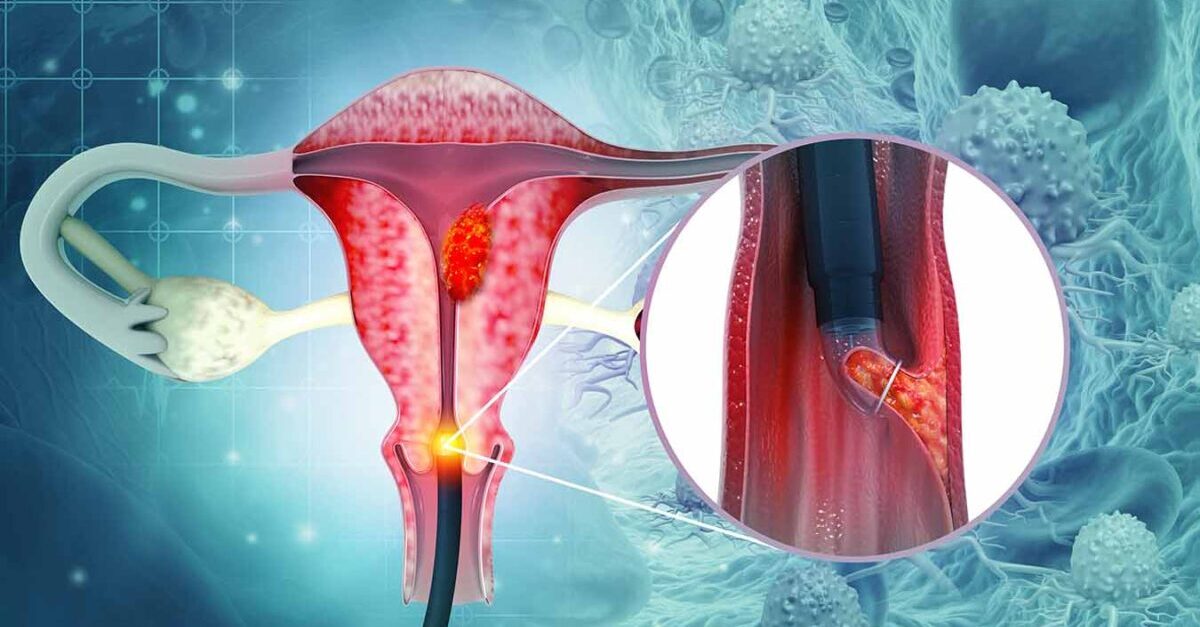 What is cervical cancer