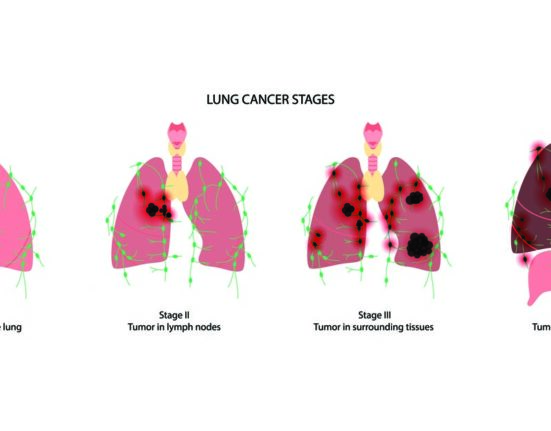 Chart showing stages of lung cancer
