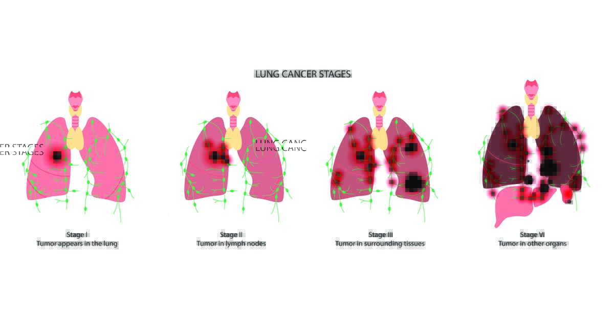Chart showing stages of lung cancer