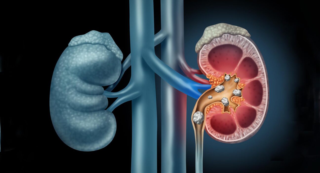 Kidney stones in Singapore