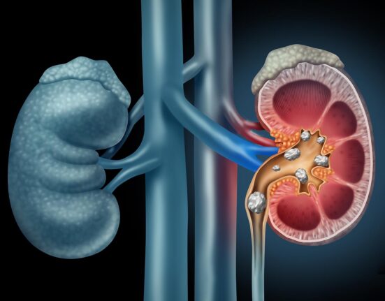 Kidney stones in Singapore