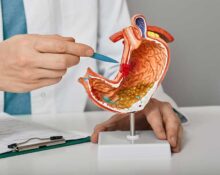 Gastric Cancer