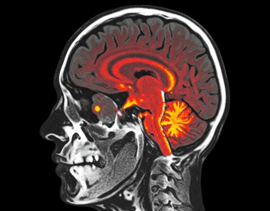 Apa Itu PET CT Scan, Manfaat, hingga Prosesnya