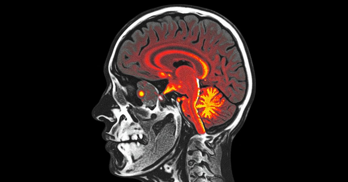 Apa Itu PET CT Scan, Manfaat, hingga Prosesnya