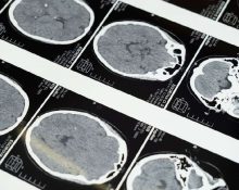 Besaran Biaya MRI di Malaysia dan Rekomendasi Rujukannya