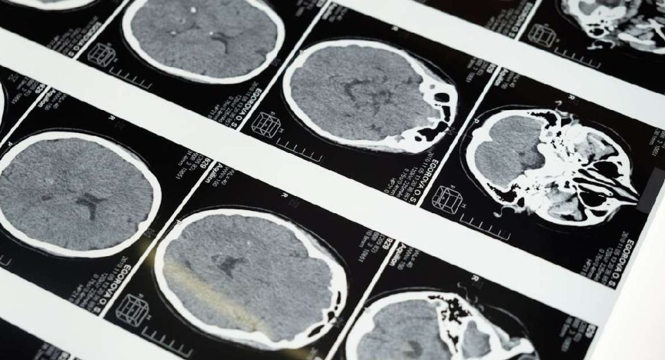 Besaran Biaya MRI di Malaysia dan Rekomendasi Rujukannya