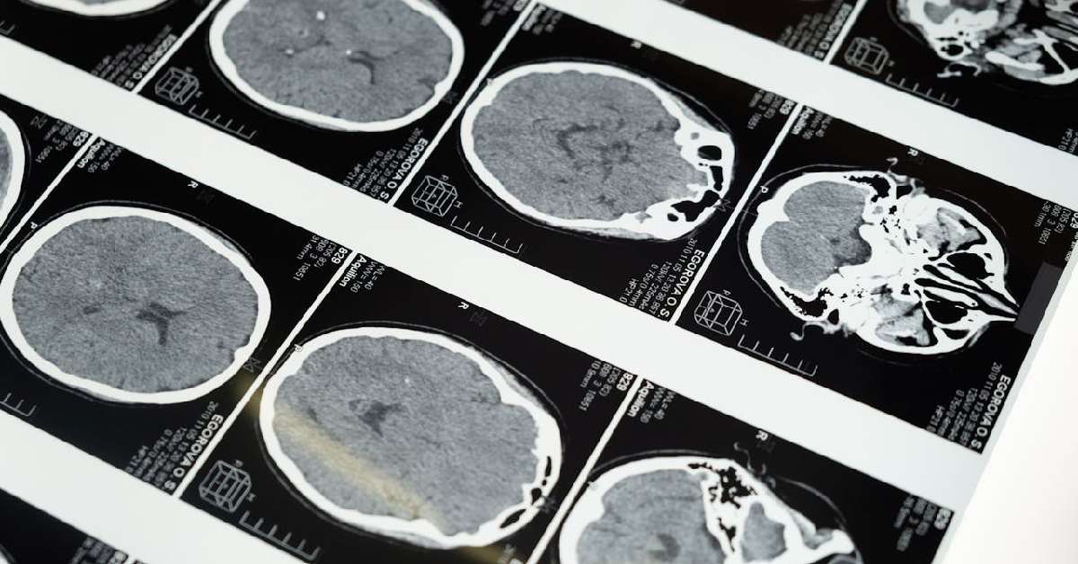 Besaran Biaya MRI di Malaysia dan Rekomendasi Rujukannya