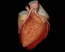 CT Angiografi Jantung & Koroner - Tujuan, Prosedur, hingga Kelebihannya