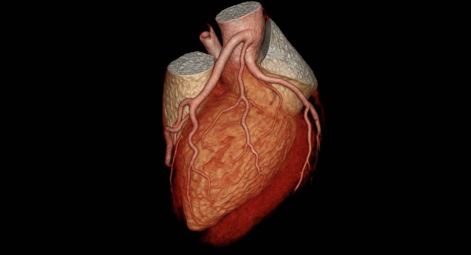 CT Angiografi Jantung & Koroner - Tujuan, Prosedur, hingga Kelebihannya