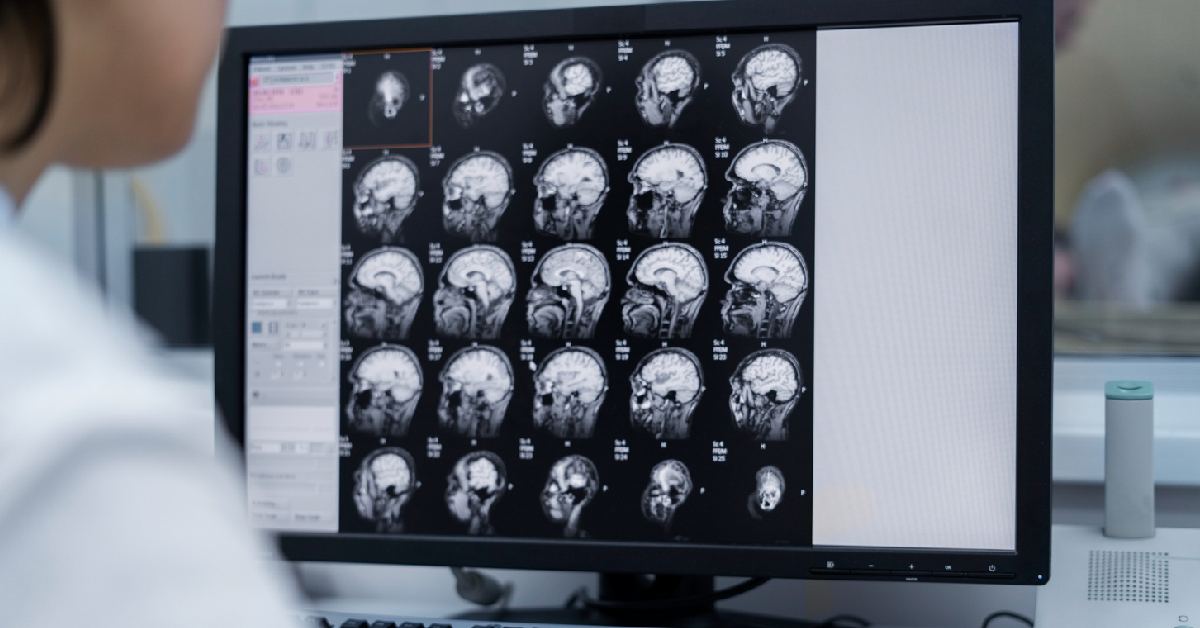 CT Scan Kepala - Jenis, Peruntukkan, hingga Prosesnya