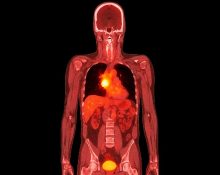 Ilustrasi PET CT Scan Kanker Paru