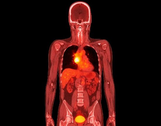 Ilustrasi PET CT Scan Kanker Paru