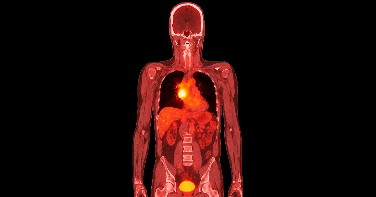 Ilustrasi PET CT Scan Kanker Paru