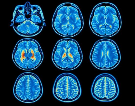 Kenali Seputar Fluorodeoxyglucose PET Scan (FDG PET Scan)