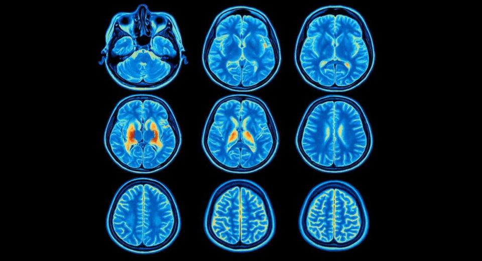 Kenali Seputar Fluorodeoxyglucose PET Scan (FDG PET Scan)