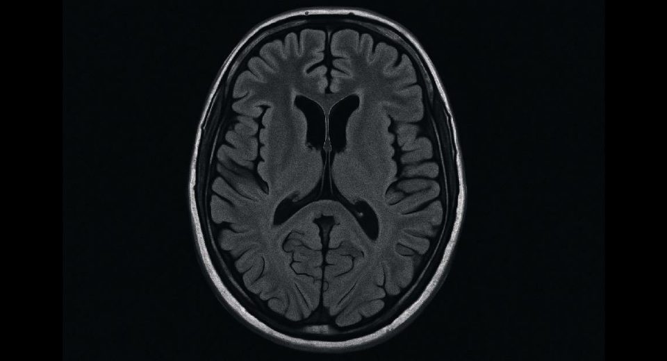 MRI Kepala/Otak