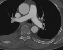 Mengenal Apa Itu CT Pulmonary Angiography atau CT Pulmonary Angiogram