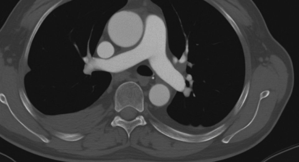 Mengenal Apa Itu CT Pulmonary Angiography atau CT Pulmonary Angiogram
