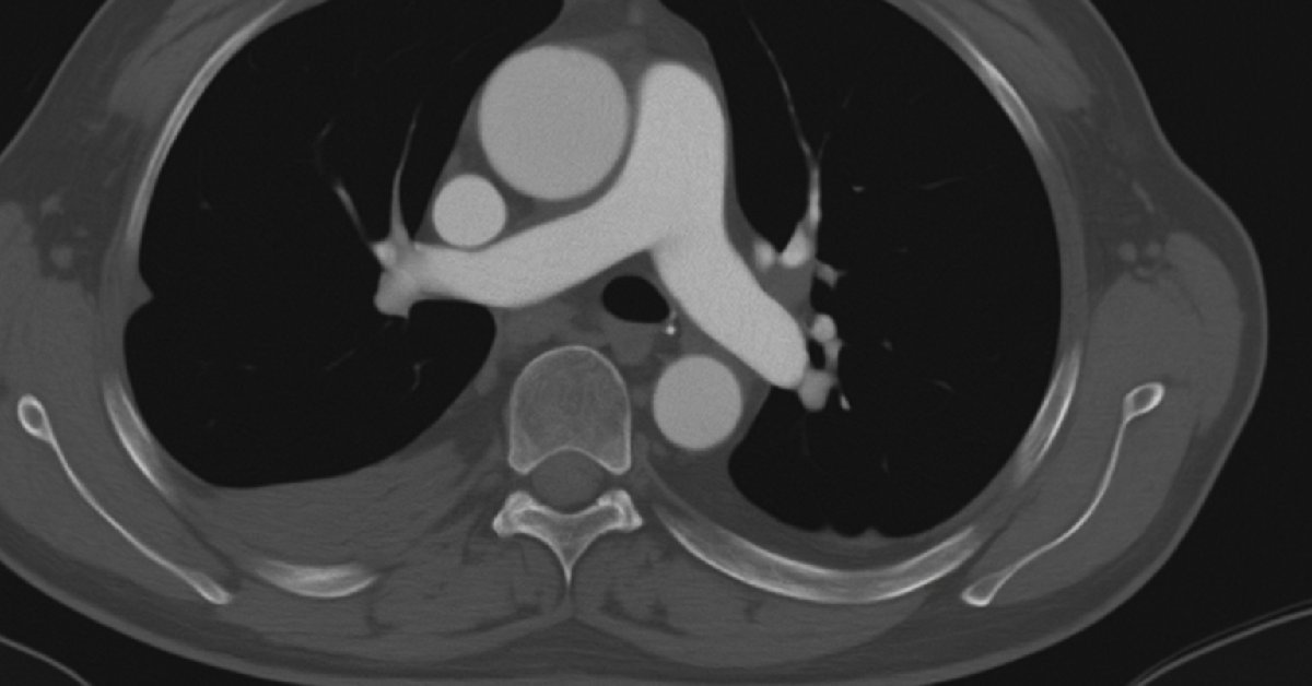 Mengenal Apa Itu CT Pulmonary Angiography atau CT Pulmonary Angiogram