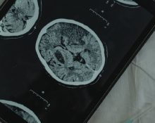Apakah CT Scan Ditanggung BPJS, Ini Syarat dan Prosedur Pengajuannya