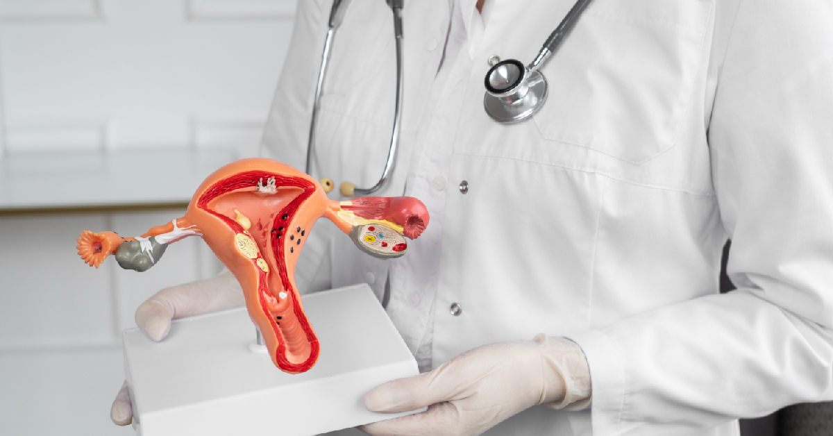 Panduan Cara Diagnosis Sindrom Polikistik Ovarium (PCOS)
