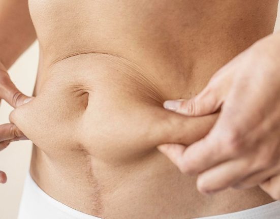 Estimasi Biaya Tummy Tuck di Thailand