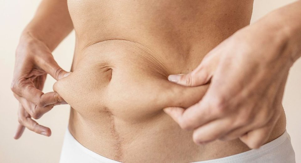 Estimasi Biaya Tummy Tuck di Thailand