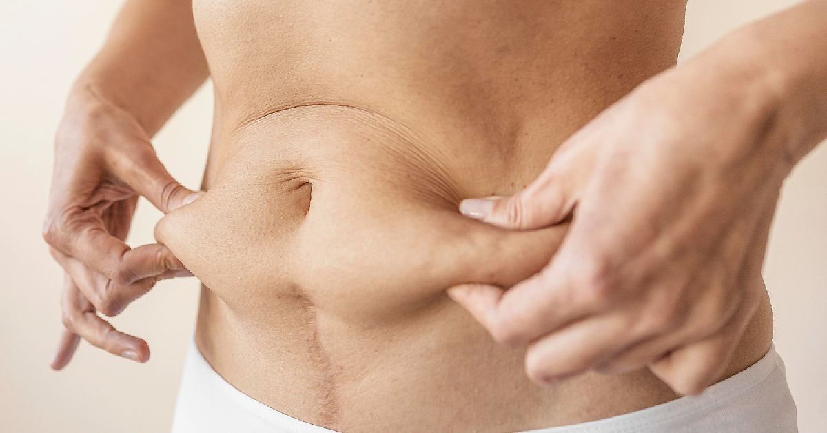 Estimasi Biaya Tummy Tuck di Thailand