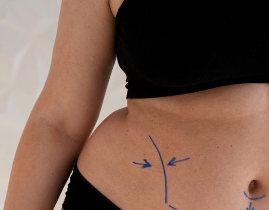 Ini Estimasi Harga Tummy Tuck di Malaysia