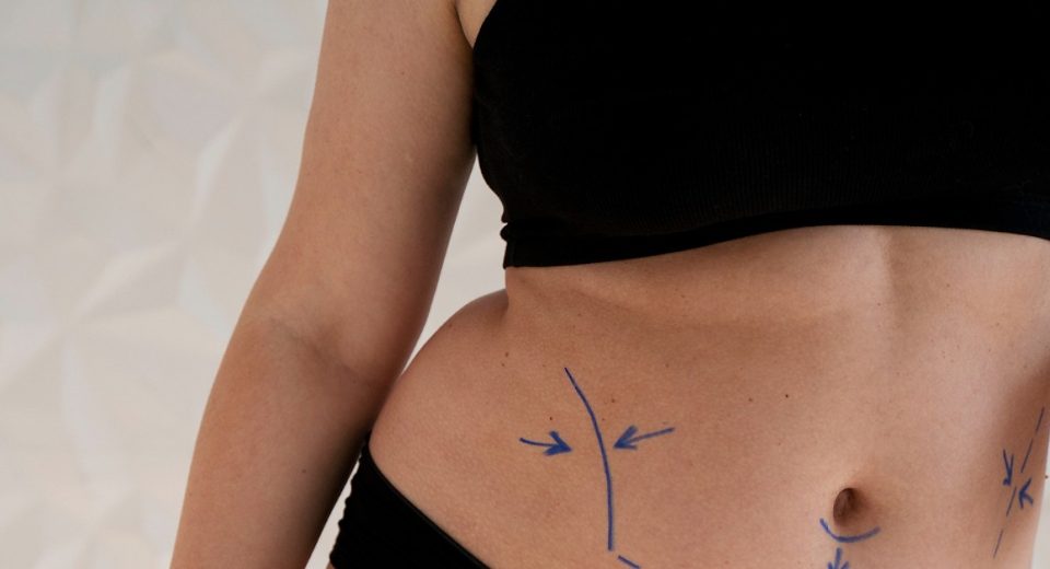 Ini Estimasi Harga Tummy Tuck di Malaysia