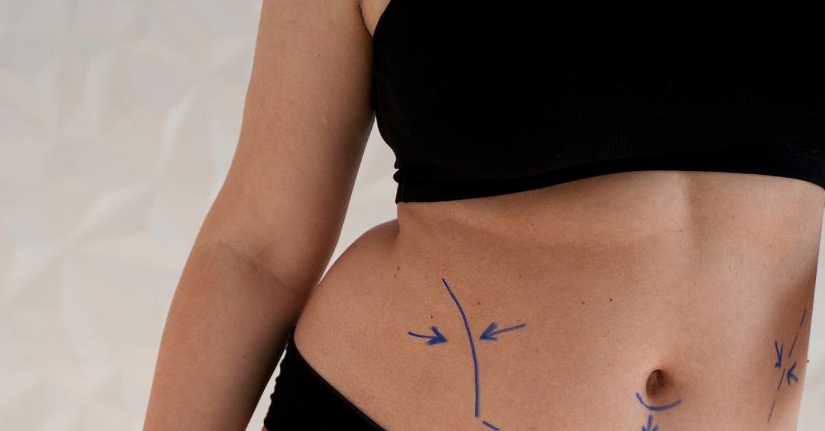 Ini Estimasi Harga Tummy Tuck di Malaysia