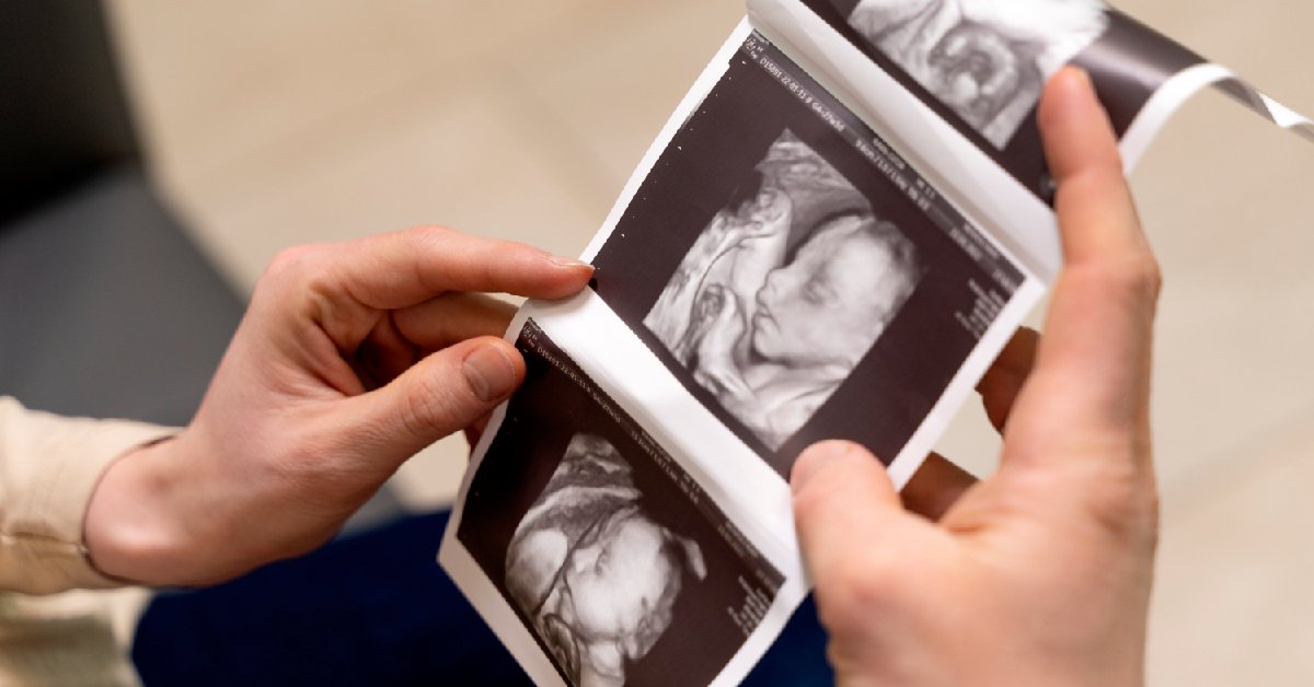 Ini Tahapan Prosedur Bayi Tabung dari Awal hingga Akhir