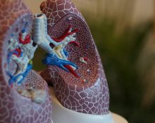 Pentingnya Low Dose CT Scan untuk Kanker Paru-paru dan Mengapa Rontgen Dada Tidak Cukup untuk Skrining Kanker