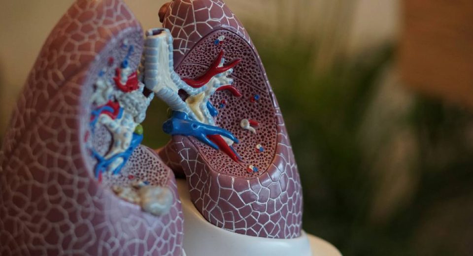 Pentingnya Low Dose CT Scan untuk Kanker Paru-paru dan Mengapa Rontgen Dada Tidak Cukup untuk Skrining Kanker