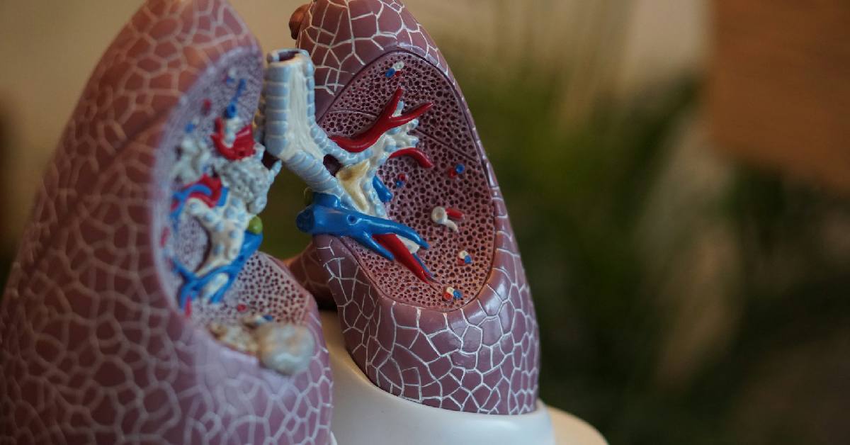 Pentingnya Low Dose CT Scan untuk Kanker Paru-paru dan Mengapa Rontgen Dada Tidak Cukup untuk Skrining Kanker