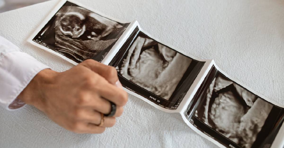 Ini 8 Syarat Bayi Tabung Sebelum Lakukan Prosedurnya
