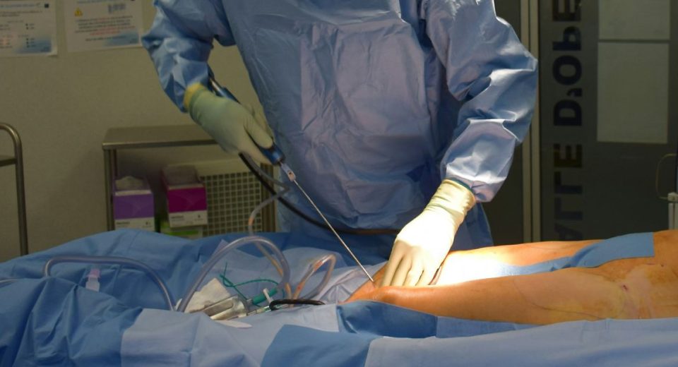 Laser Liposuction