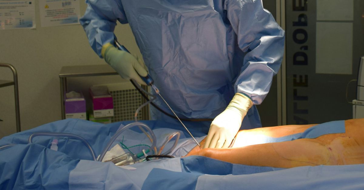 Laser Liposuction