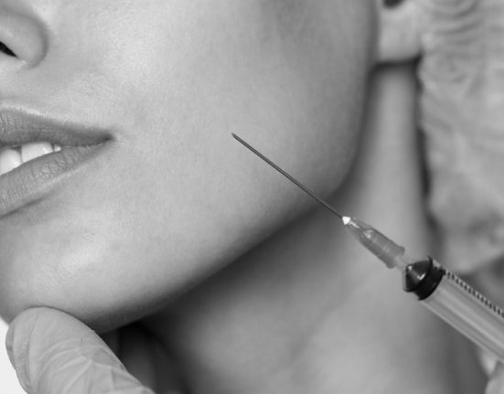 Mengenal Filler Smile Line, Prosedur, dan Manfaatnya
