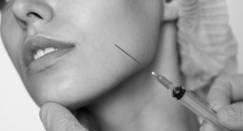 Mengenal Filler Smile Line, Prosedur, dan Manfaatnya