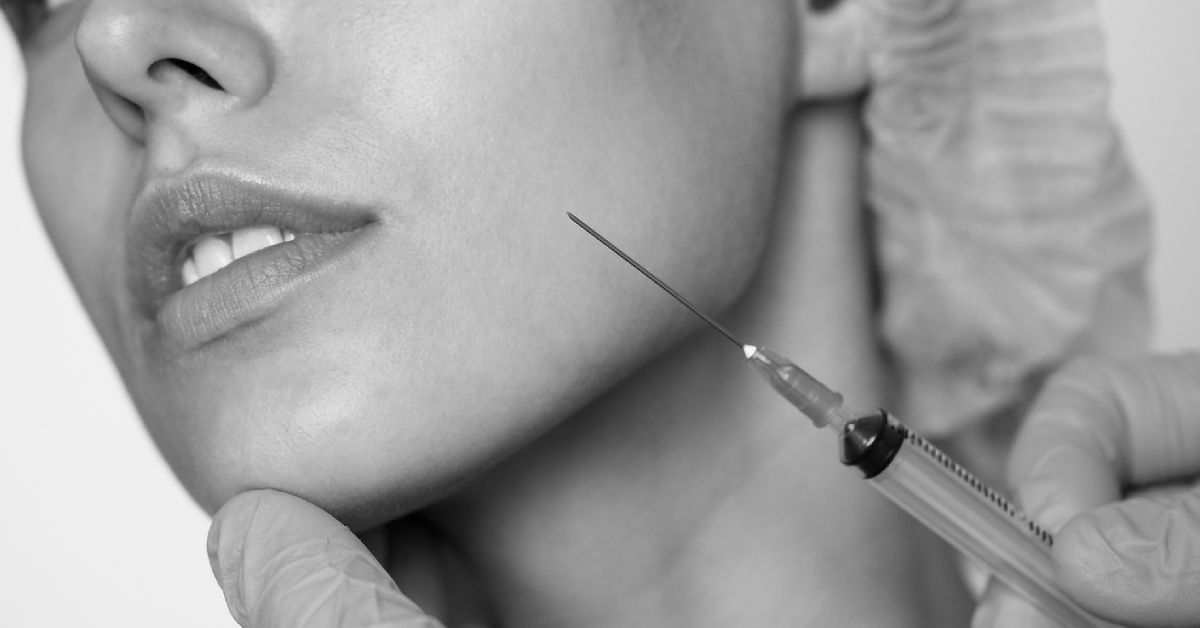 Mengenal Filler Smile Line, Prosedur, dan Manfaatnya