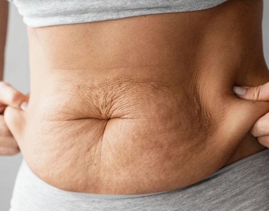 Mini Tummy Tuck atau Tummy Tuck Parsial