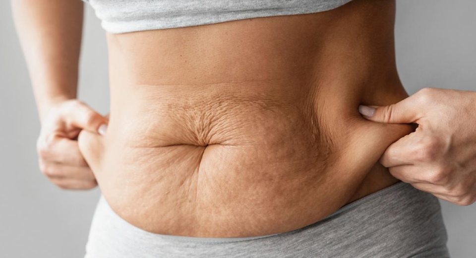 Mini Tummy Tuck atau Tummy Tuck Parsial