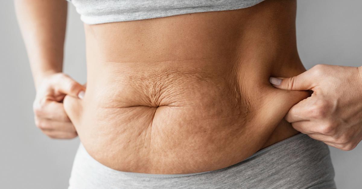 Mini Tummy Tuck atau Tummy Tuck Parsial