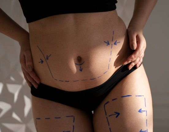 Prosedur Sedot Lemak atau Liposuction