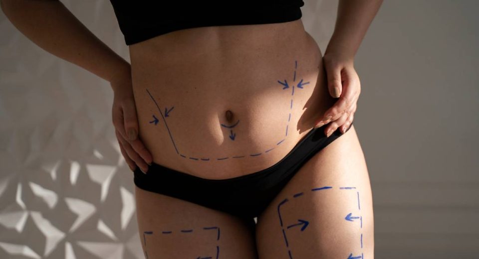 Prosedur Sedot Lemak atau Liposuction