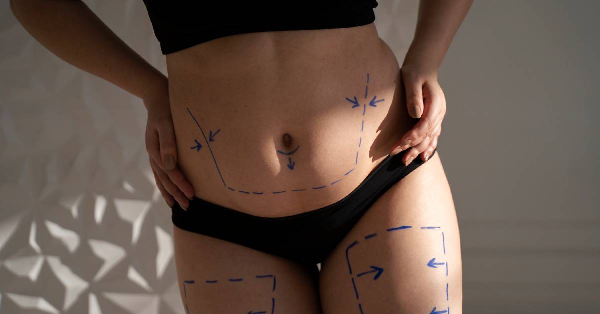 Prosedur Sedot Lemak atau Liposuction
